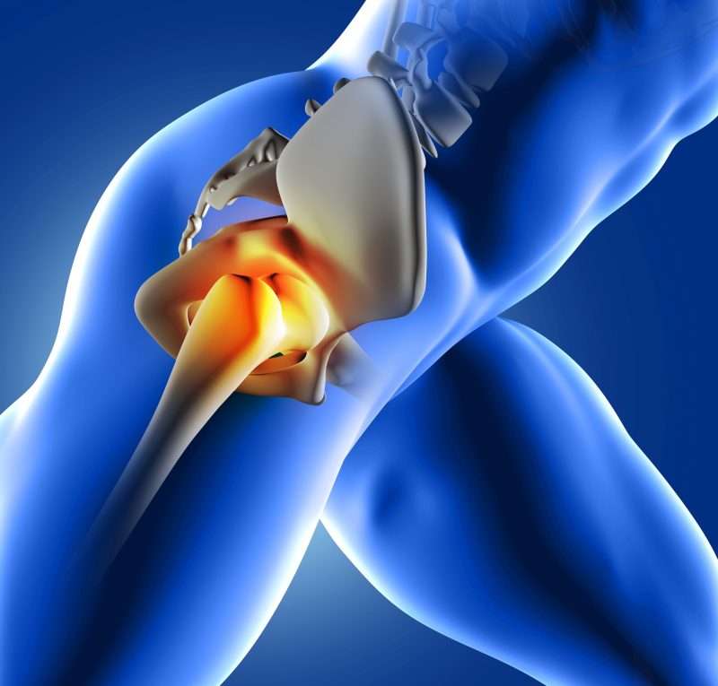 Treatment And Prevention Of Hip Pain | Avant Orthopaedics