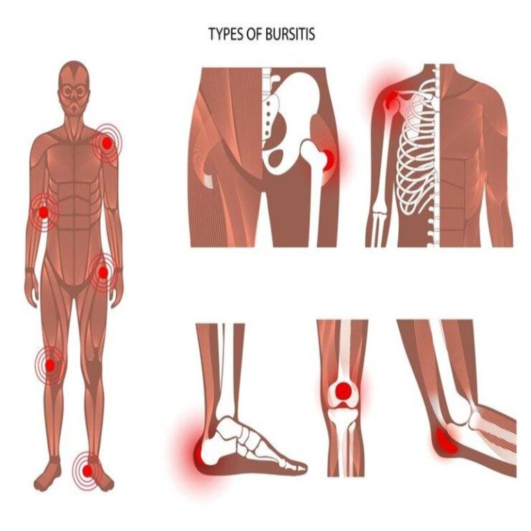 Types Of Bursitis | Avant Orthopaedics
