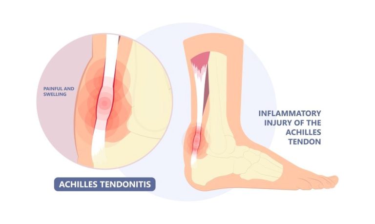 An Illustration Depicting Achilles Tendinitis At The Back Of The Foot