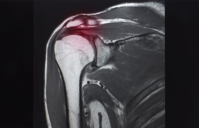A Close Up Shot Of An X Ray Highlighting Rotator Cuff Tears On The Right Shoulder